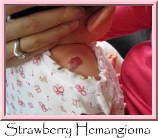 Strawberry Hemangioma  Thumbnail