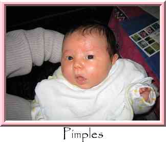Pimples Thumbnail